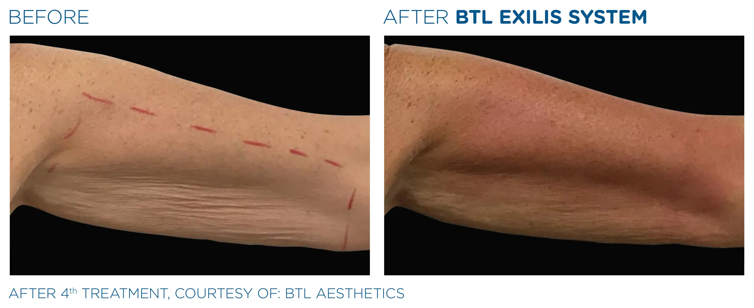 Clínica de Fitness | EMTONE BTL_Exilis_antes y despues 2