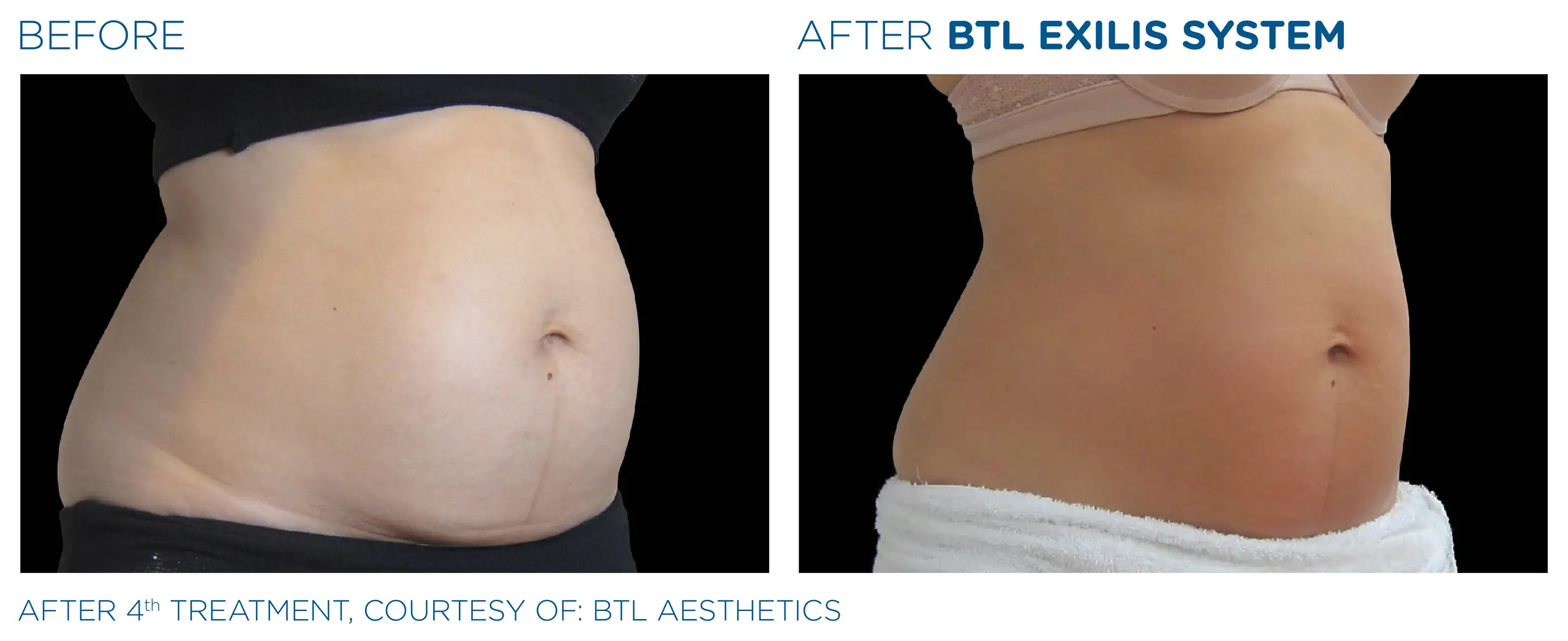 Clínica de Fitness | EMTONE BTL_Exilis_antes y despues 5
