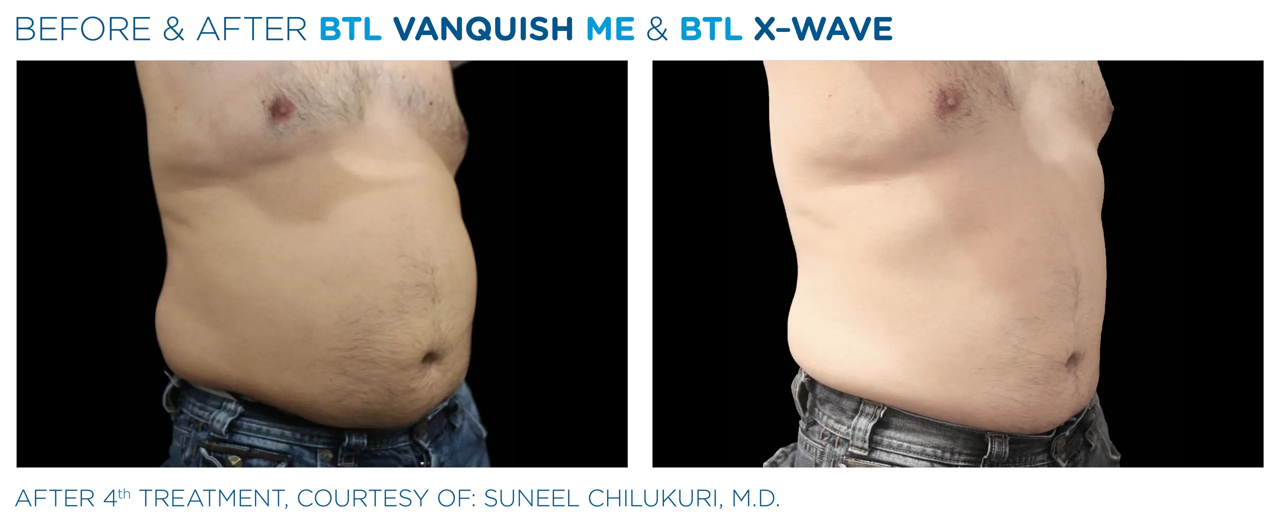 Clínica de Fitness | EMTONE BTL_X-Wave_Vanquish-ME- antes y despues 3