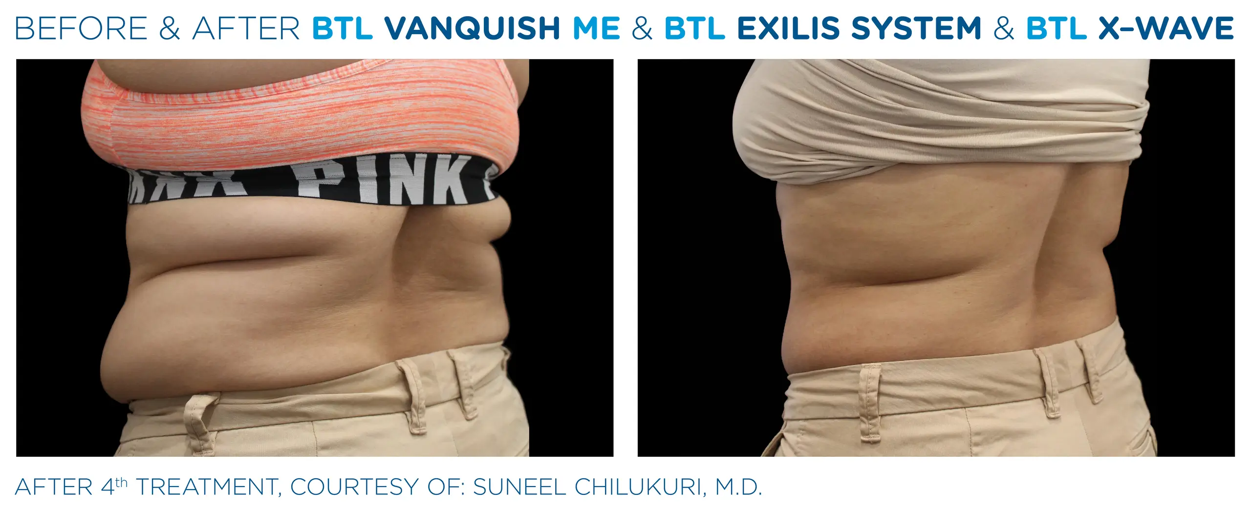 Clínica de Fitness | EMTONE BTL_X-Wave_Vanquish-ME- antes y despues 4