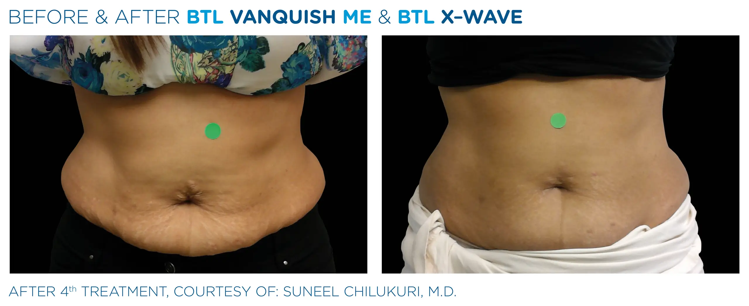 Clínica de Fitness | EMTONE BTL_X-Wave_Vanquish-ME- antes y despues 5