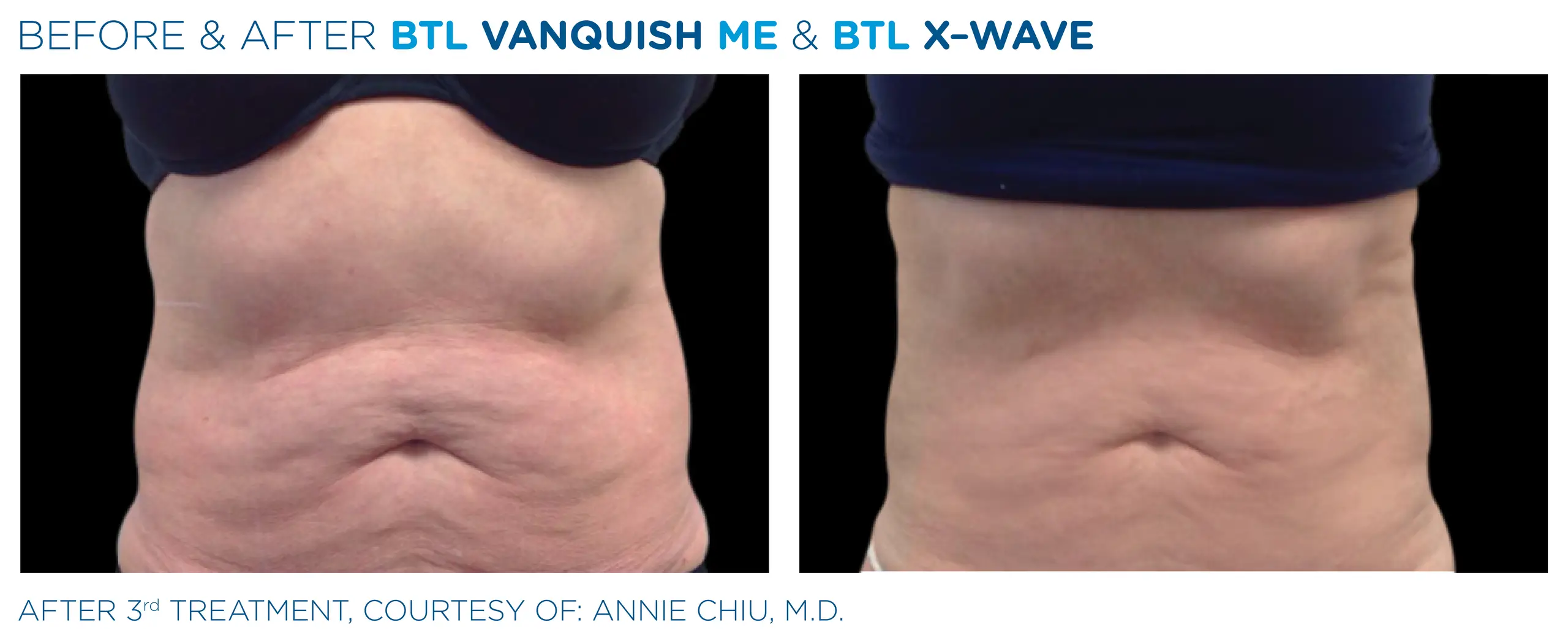 Clínica de Fitness | EMTONE BTL_X-Wave_Vanquish-ME- antes y despues 6