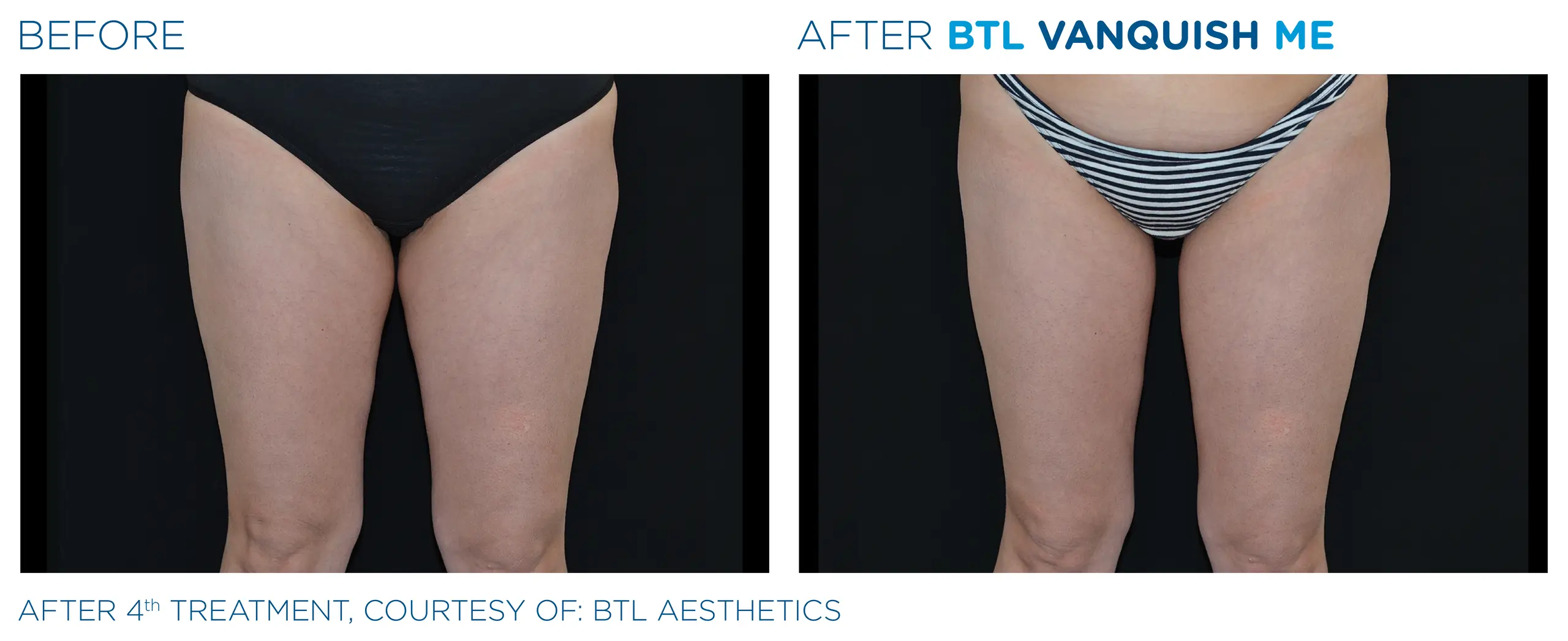 Clínica de Fitness | EMTONE BTL_X-Wave_Vanquish-ME- antes y despues 7