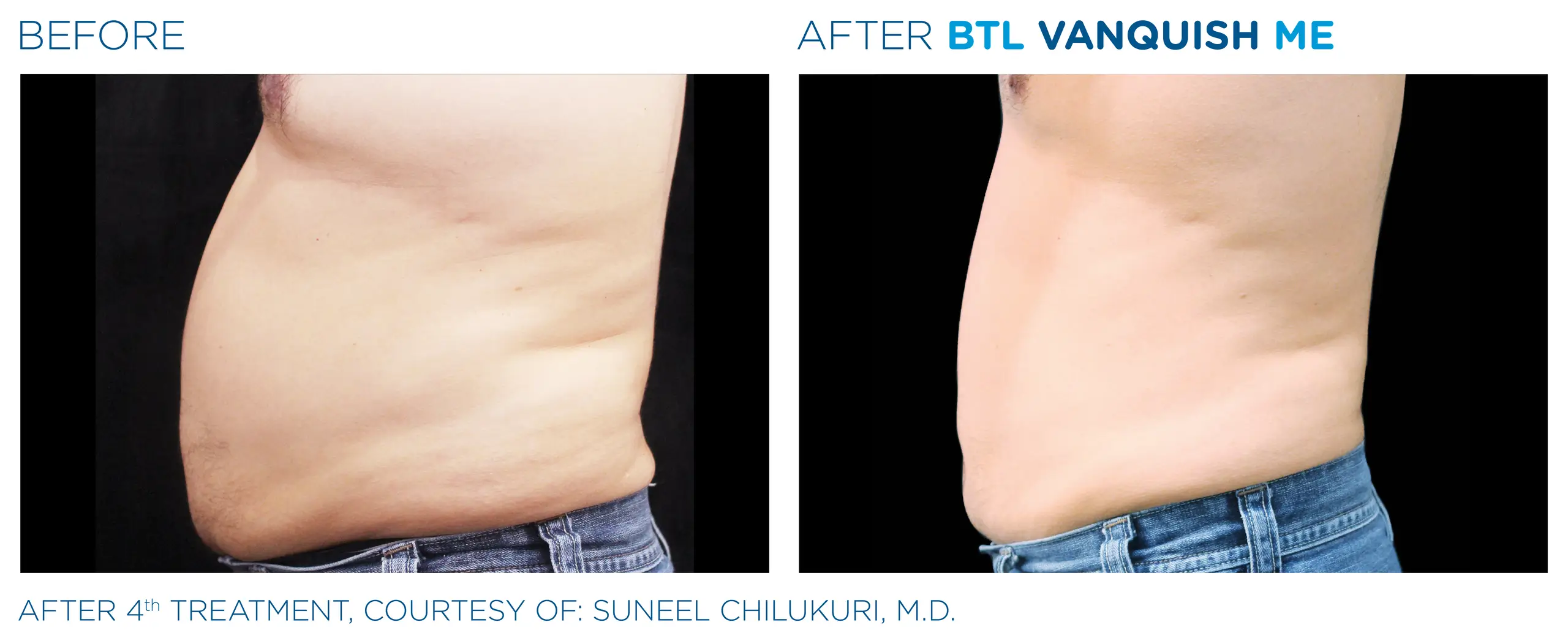 Clínica de Fitness | BODY BY BTL_X-Wave_Vanquish-ME- antes y despues 9