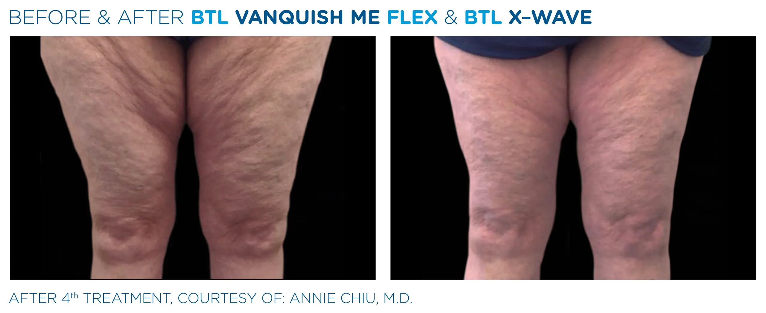 Clínica de Fitness | EMTONE BTL_X-Wave_Vanquish-ME- antes y despues