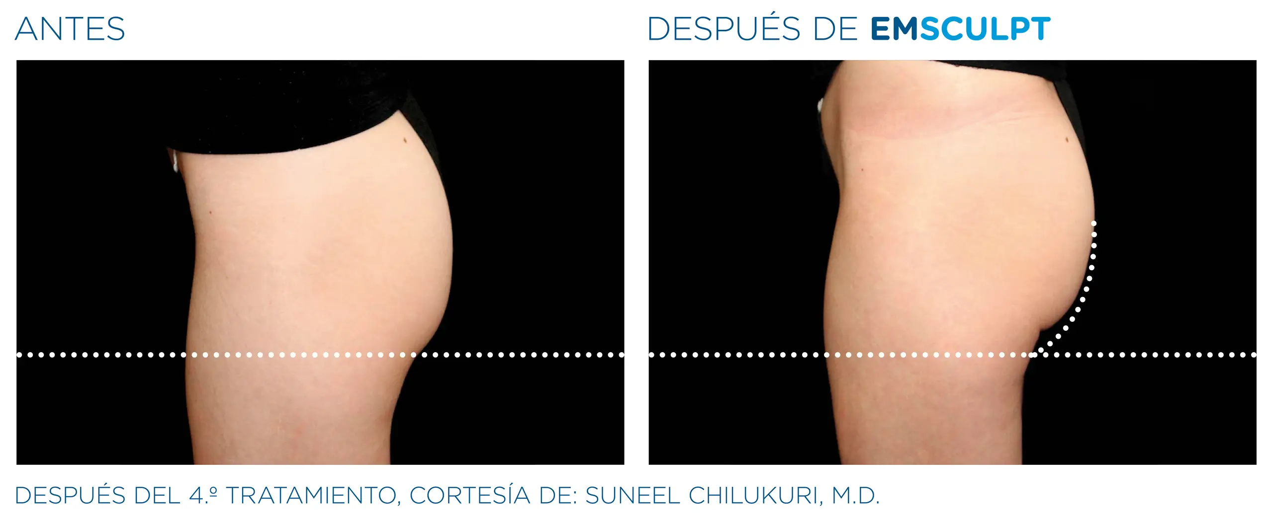 Clínica de Fitness | BODY BY Emsculpt_antes y despues 2