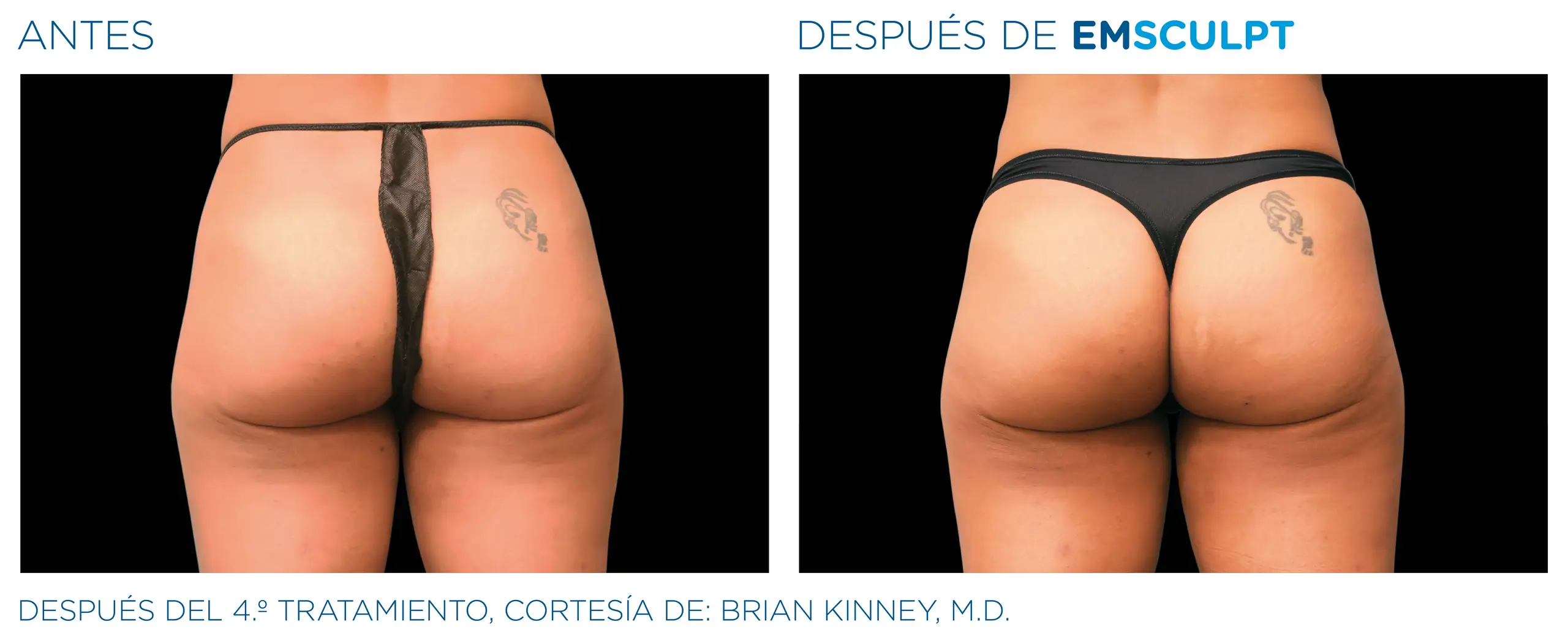 Clínica de Fitness | EMSCULPT Emsculpt_antes y despues 4