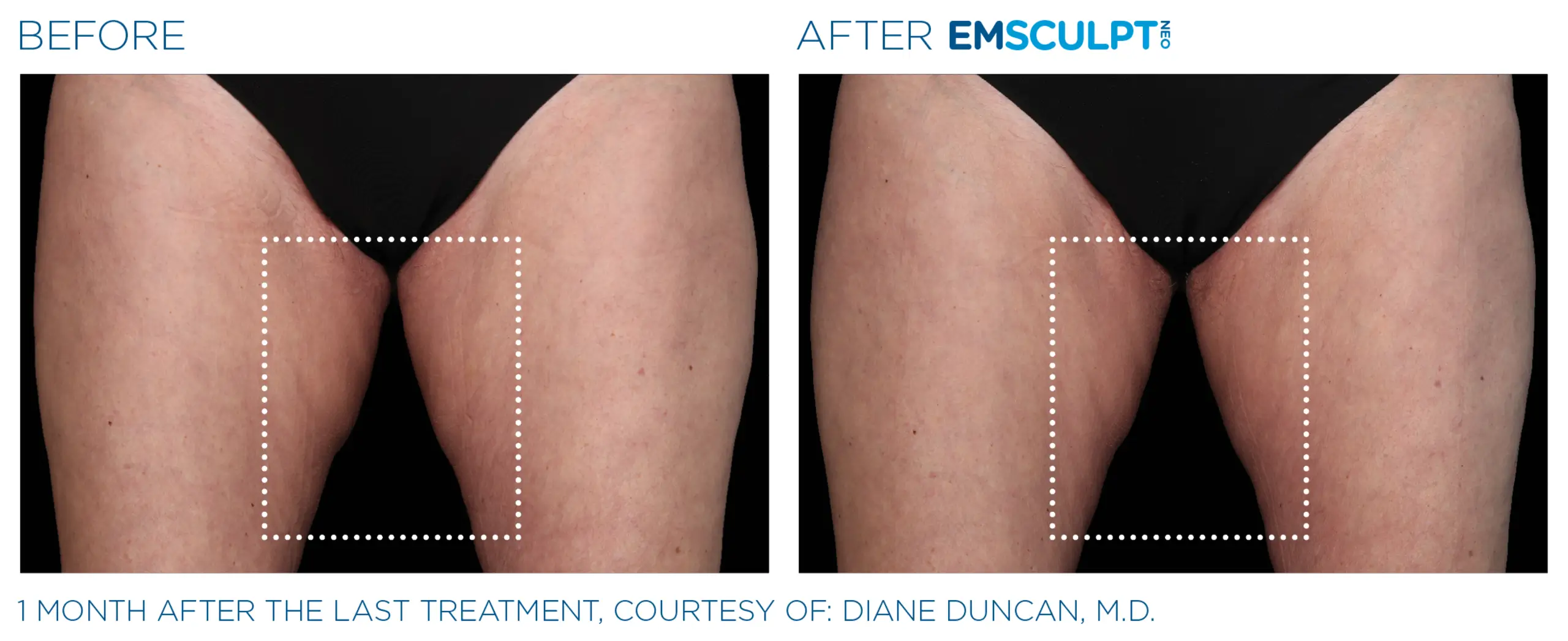 Clínica de Fitness | EMSCULPT Emsculpt_neo_ antes y despues 2