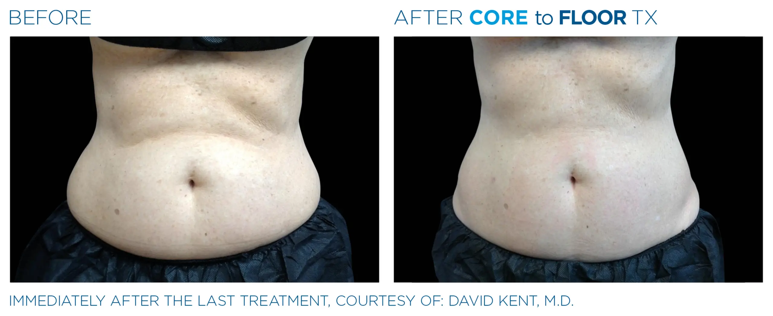 Clínica de Fitness | EMTONE Emsculpt_neo_ antes y despues 3