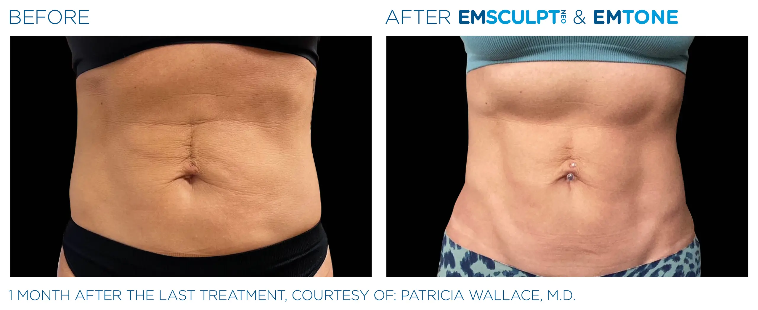 Clínica de Fitness | EMSCULPT Emsculpt_neo_ antes y despues 4