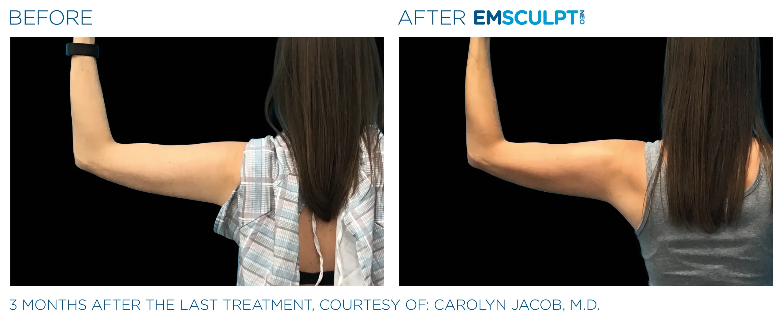 Clínica de Fitness | EMSCULPT Emsculpt_neo_ antes y despues 5