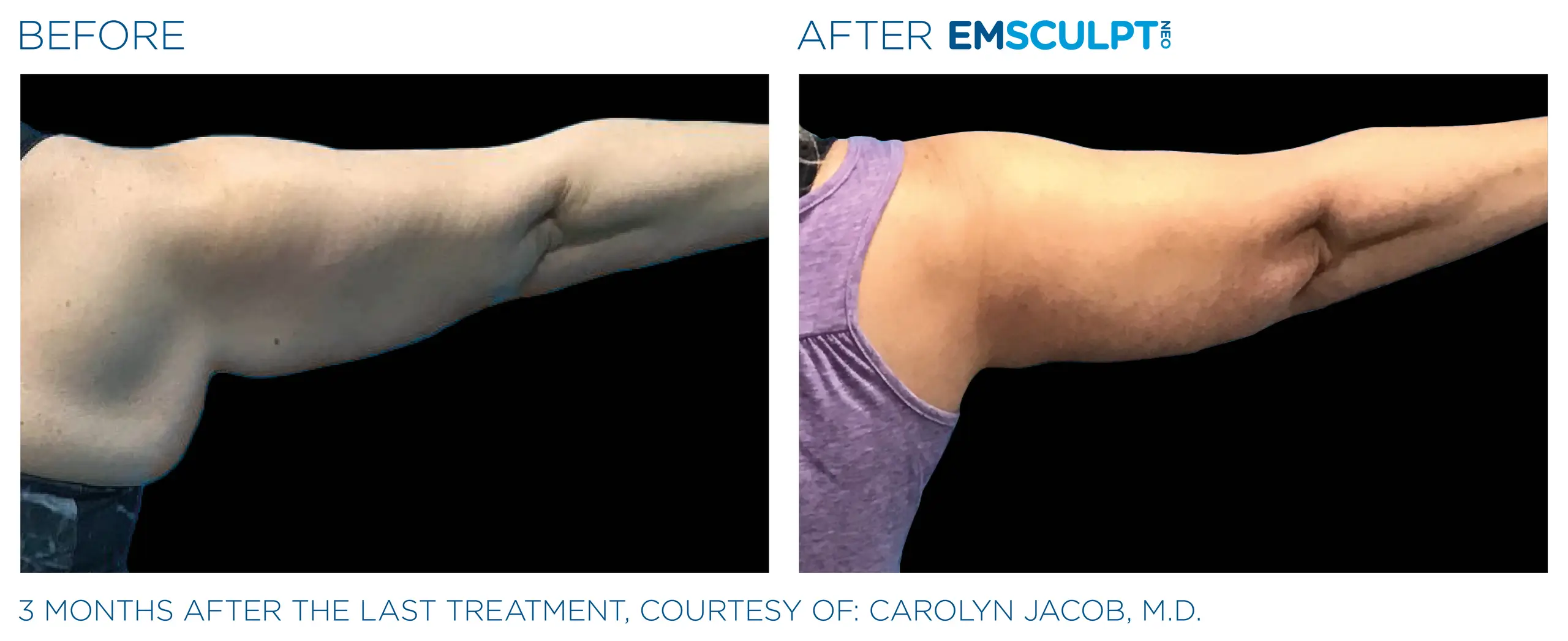 Clínica de Fitness | EMSCULPT Emsculpt_neo_ antes y despues 6