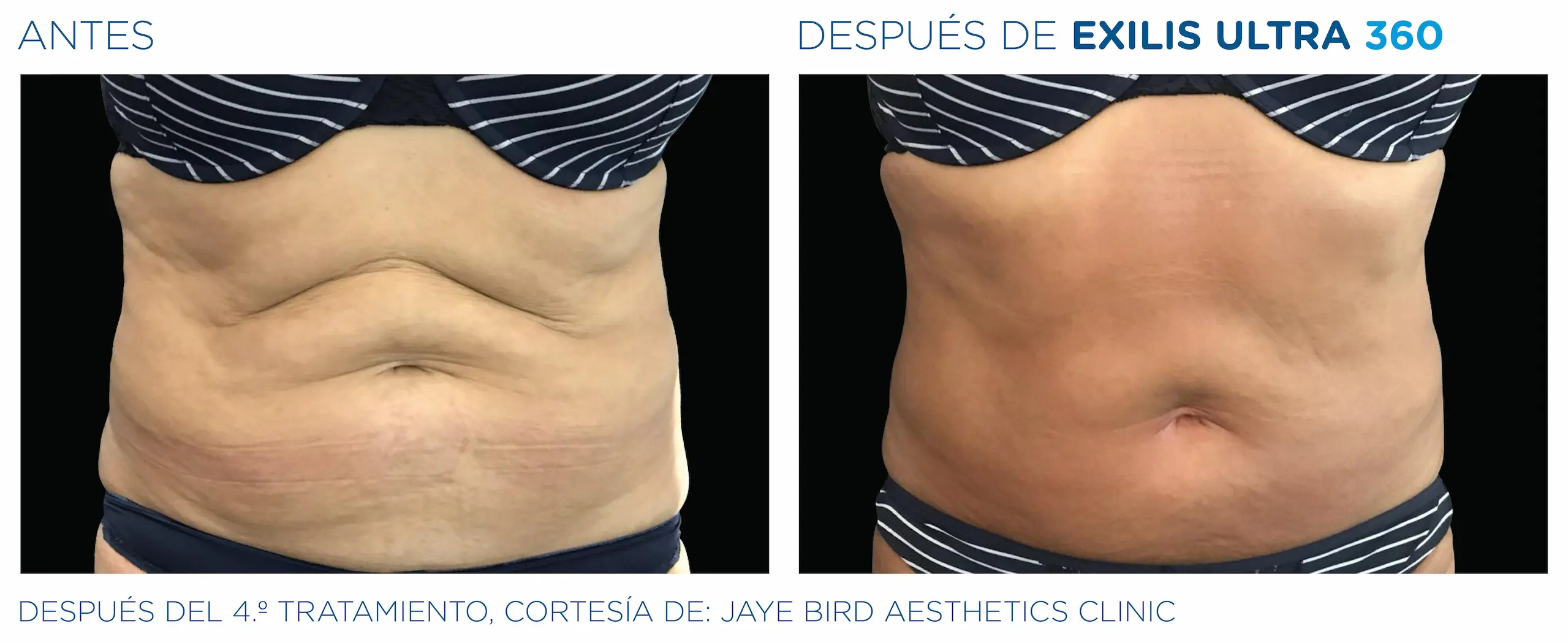 Clínica de Fitness | EXILIS ULTRA Exilis_Ultra_360_CASO3