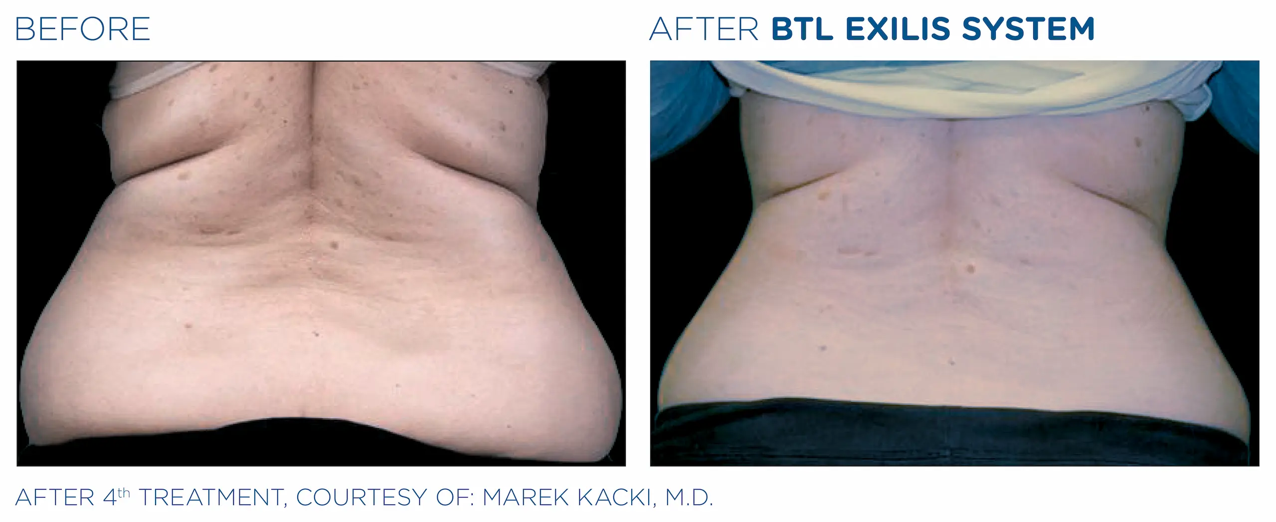 Clínica de Fitness | EXILIS ULTRA Exilis_caso1