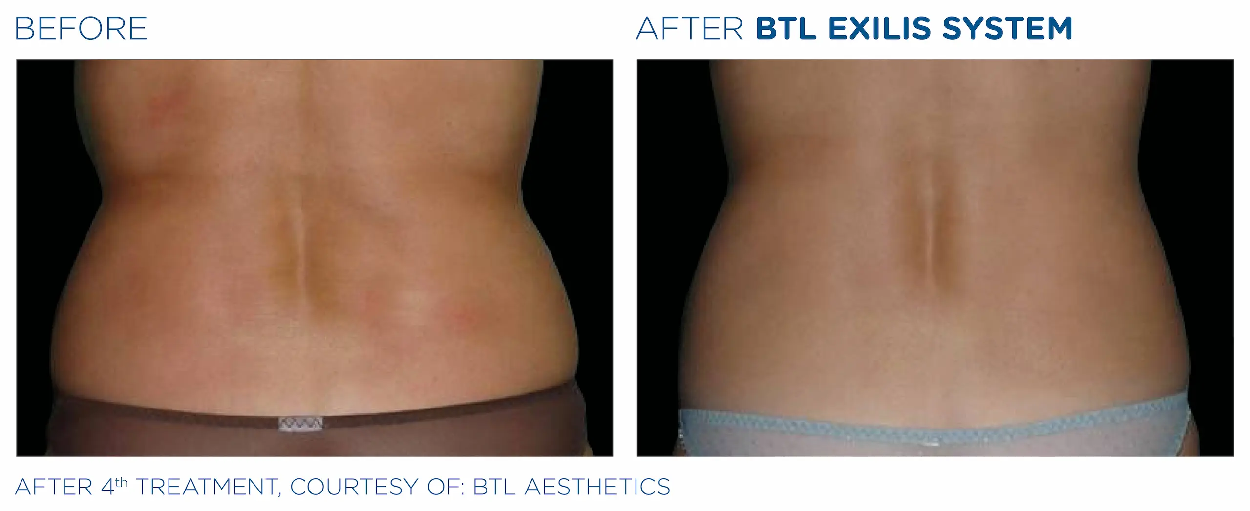 Clínica de Fitness | EXILIS ULTRA Exilis_caso2