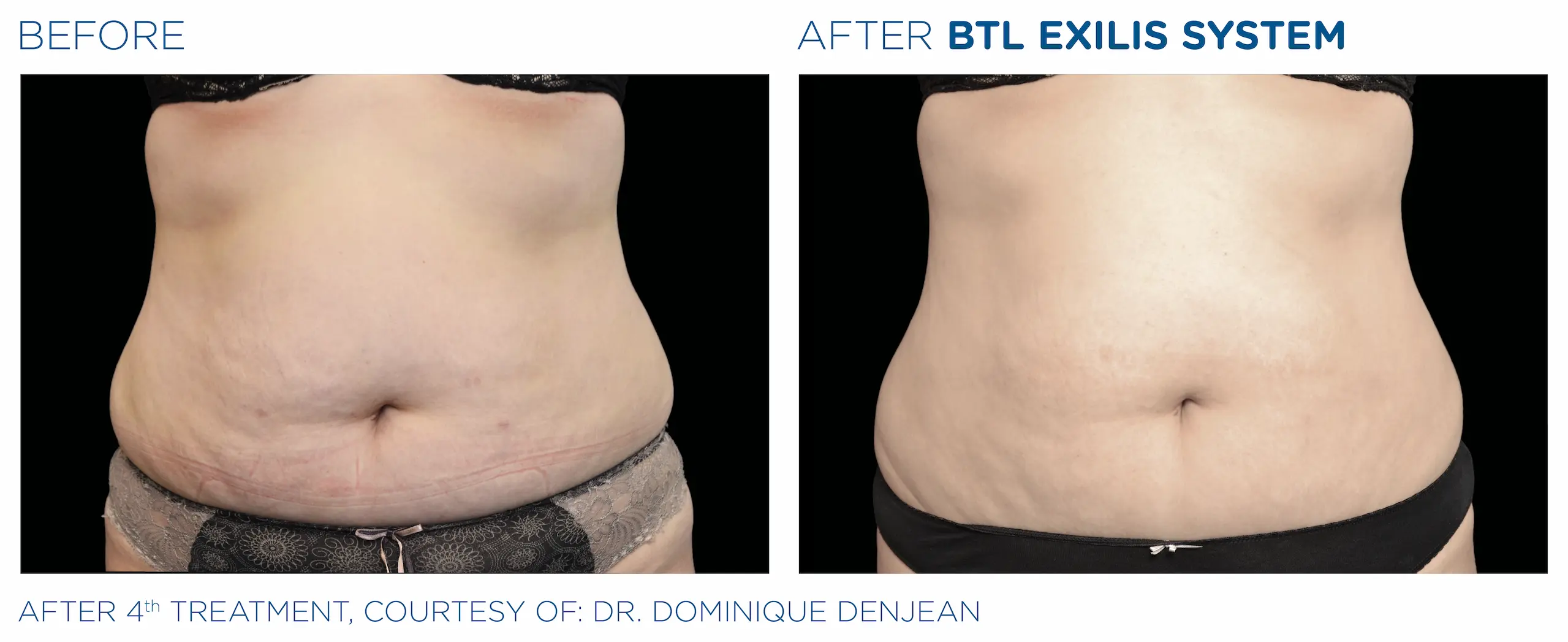 Clínica de Fitness | EXILIS ULTRA Exilis_caso4