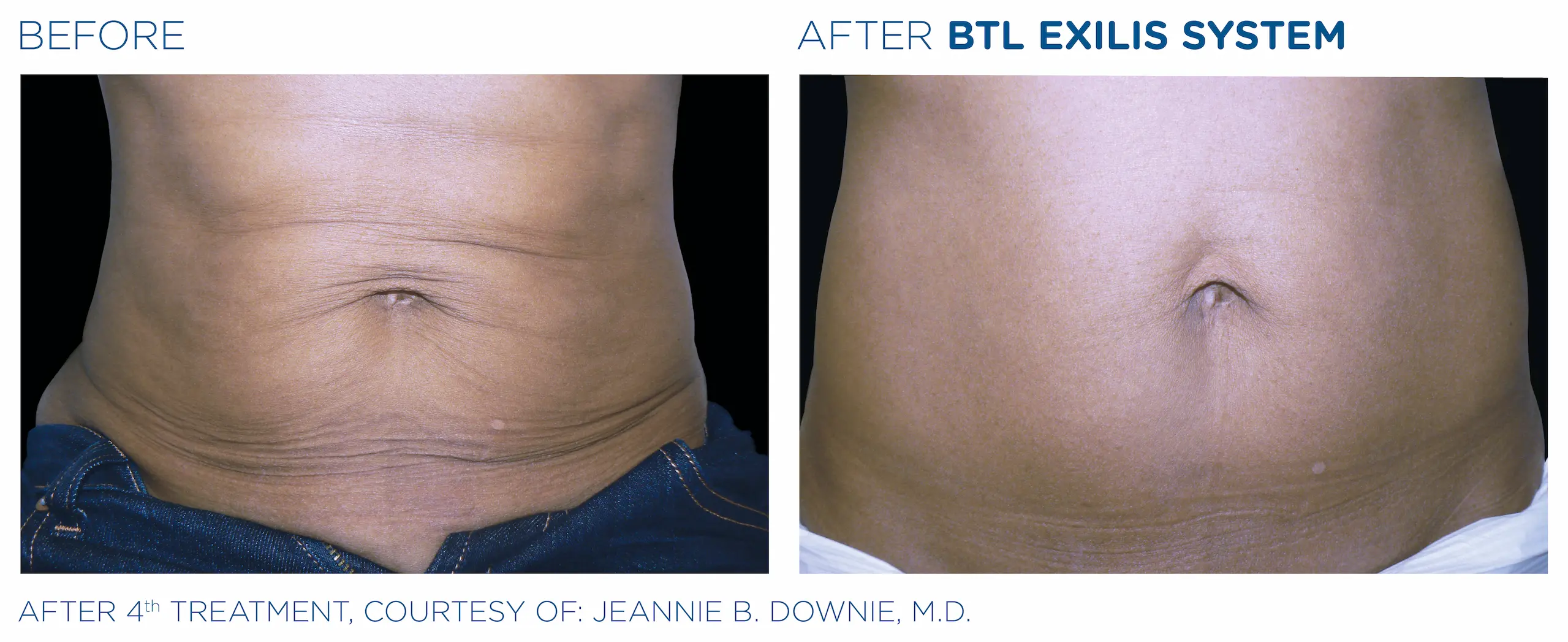 Clínica de Fitness | EXILIS ULTRA Exilis_caso5
