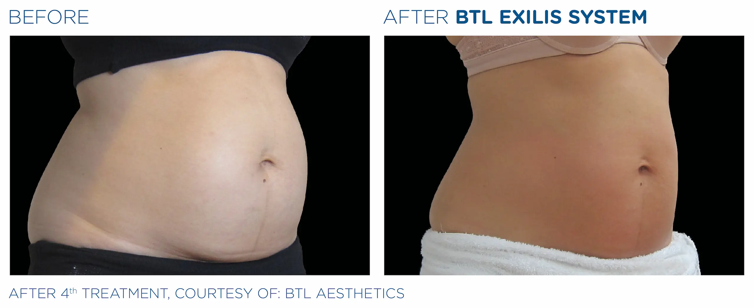 Clínica de Fitness | EXILIS ULTRA Exilis_caso6