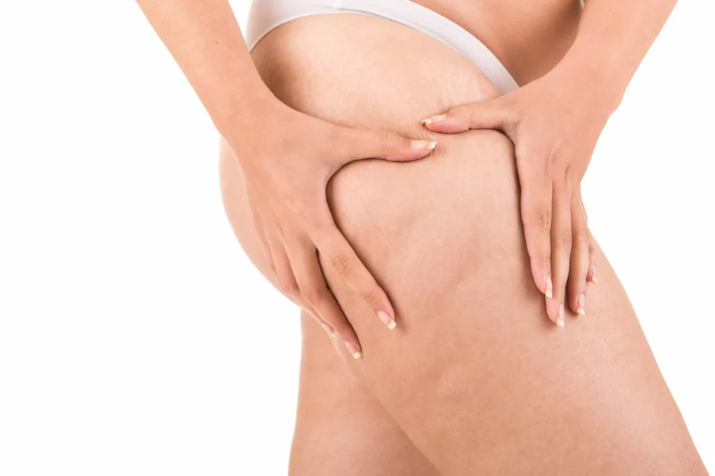 Aplicación de mesoterapia para celulitis en zona de muslos - clinica de fitness