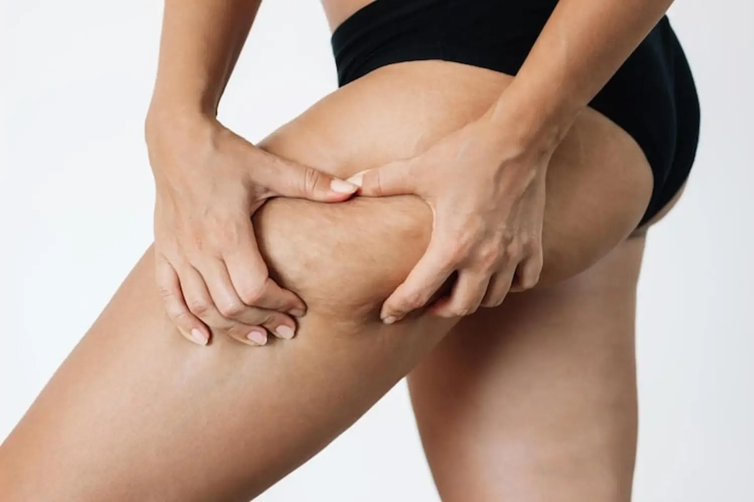Mujer mostrando piernas con celulitis y piel natural — celulitis en las piernas - clinica del fitness