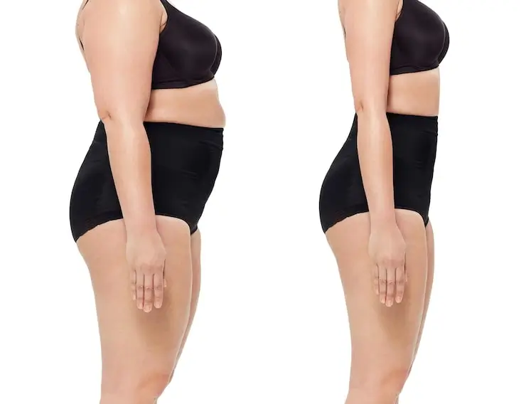 Clínica de Fitness | qué es lipedema Comparación visual entre piernas con lipedema y sin lipedema - clinica de fitness